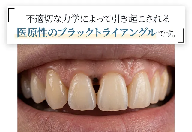 不適切な力学によって引き起こされる「医原性のブラックトライアングル」です。