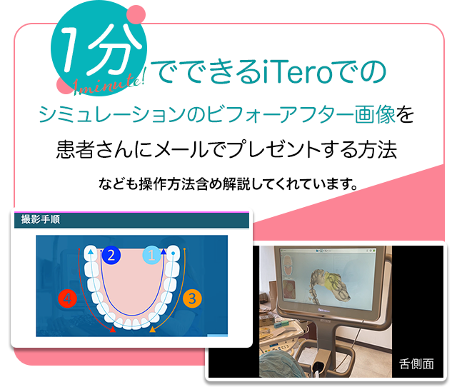 1分でできるiTeroでのシミュレーションのビフォーアフター画像