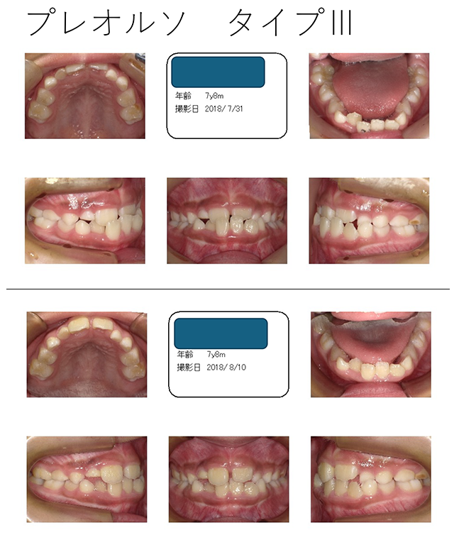 プレオルソタイプ3