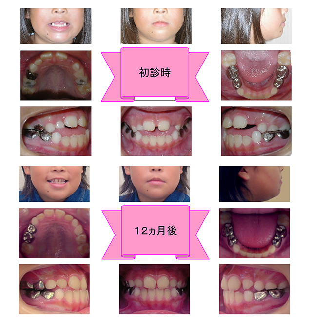 初診時、12か月後