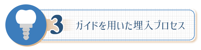 ３、【ガイドを用いた埋入プロセス】