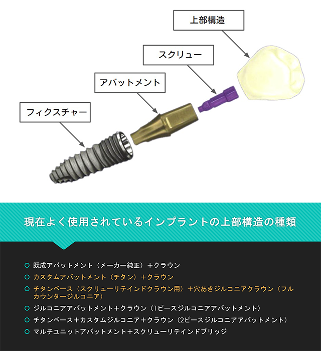 現在よく使用されているインプラントの上部構造の種類
