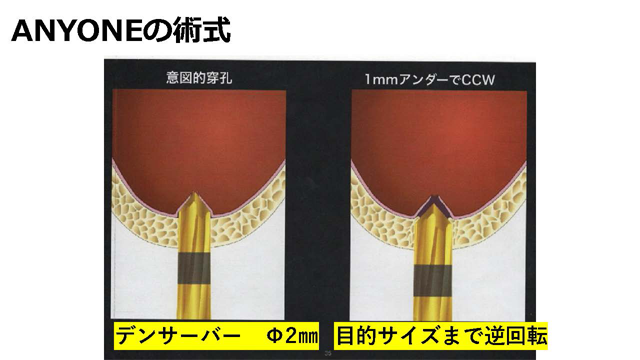 ANYONEの術式