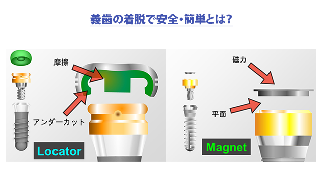 義歯の着脱で安全・簡単とは？