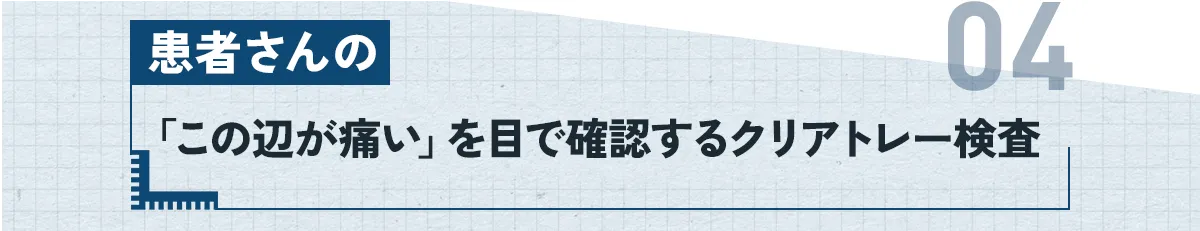 ④：患者さんの「この辺が痛い」を目で確認するクリアトレー検査