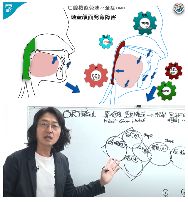 口腔機能発達不全症