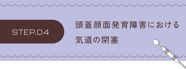 【ステップ4：頭蓋顔面発育障害でおきる気道の閉鎖】