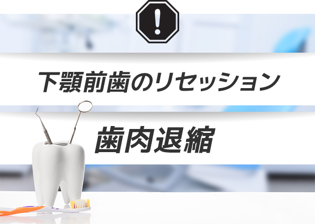 ・下顎前歯のリセッション・歯肉退縮