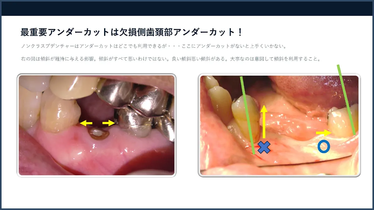 アンダーカット診断の講義スライド