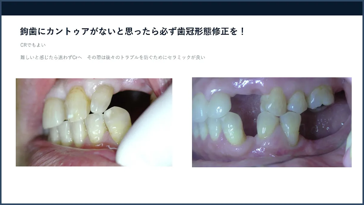 歯冠形態修正の講義スライド