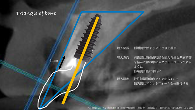 埋入位置、埋入方向、埋入深度