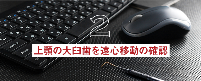 【上顎の大臼歯を遠心移動の確認】